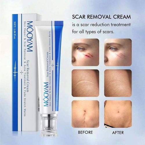 🔥 LIMITED DEAL — MOOYAM Skin Repair & Scar Removal Cream | Fades Scars + Clears Acne Marks + Removes Stretch Marks | KSh 4,320