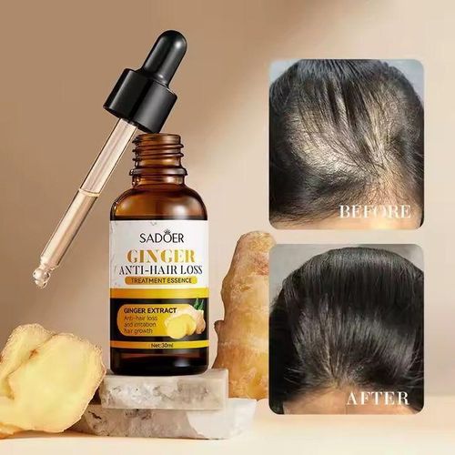 SADOER Ginger Anti Hairloss Treatment Essence, Hair Growth Restoration Anti Hair Loss Serum
