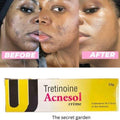 🔥🔥BUY 1 GET 1 EXTRA FREE Acnesol Tretinoin Acne Cream 25g Powerful Acne Treatment For Clearer Smoother Skin