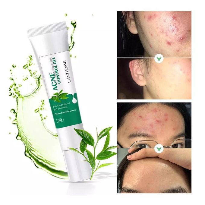 🔥 LIMITED DEAL — Lanthome Acne Control Gel 20g | Clears Pimples + Fades Blemishes + Smooths Skin | KSh 1,800