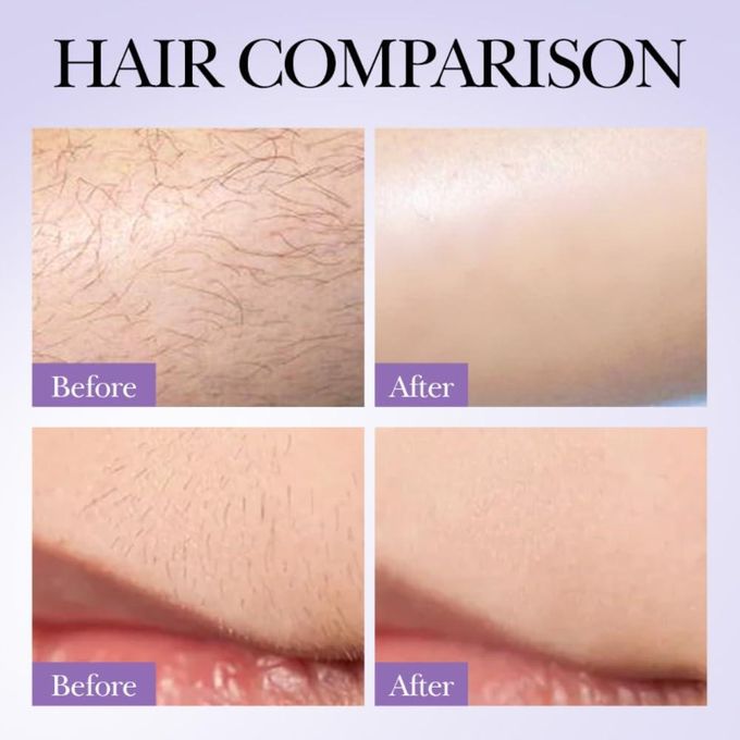 SADOER Hair Growth Inhibition Spray – 30ml