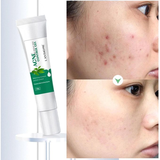 🔥 LIMITED DEAL — Lanthome Acne Control Gel 20g | Clears Pimples + Fades Blemishes + Smooths Skin | KSh 1,800