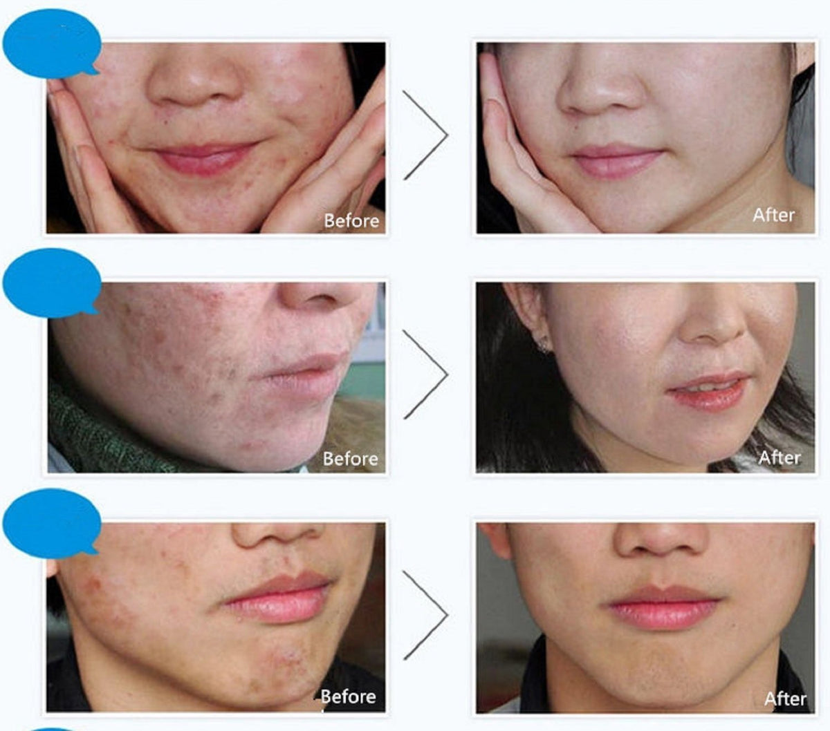 🔥 LIMITED DEAL — BIOAQUA Acne Removal Rejuvenation Cream | Clear Pimples + Fade Scars + Renew Skin | KSh 2000