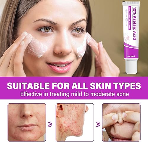 Sauvasine Azelaic Acid 12% Facial Cream with Hyaluronic Acid & Niacinamide – Fade Dark Spots, Acne & Redness C