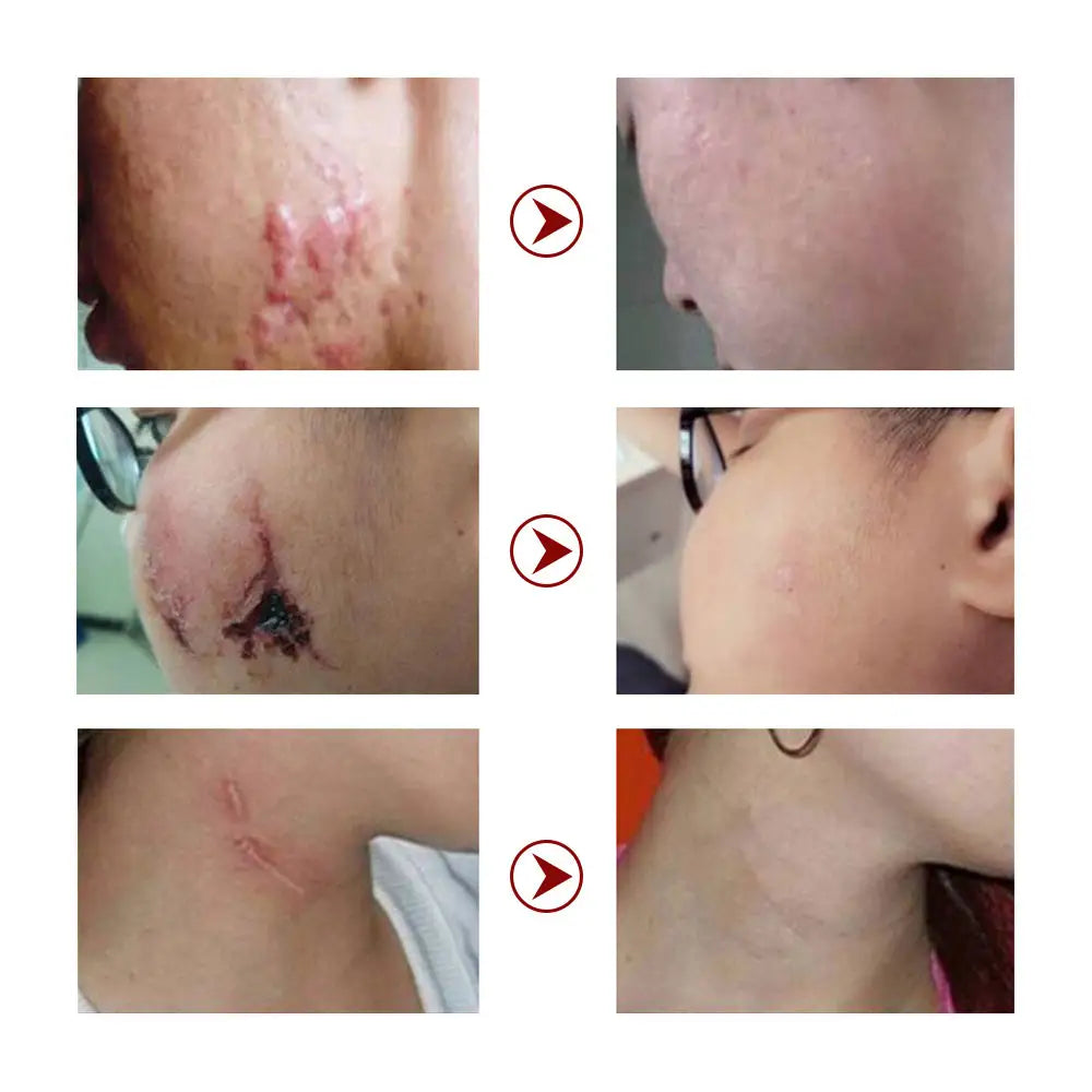 🔥 FLASH SALE — MOOYAM Acne Scar Removal Cream | Fade Dark Spots + Even Skin Tone | KSh 1,800