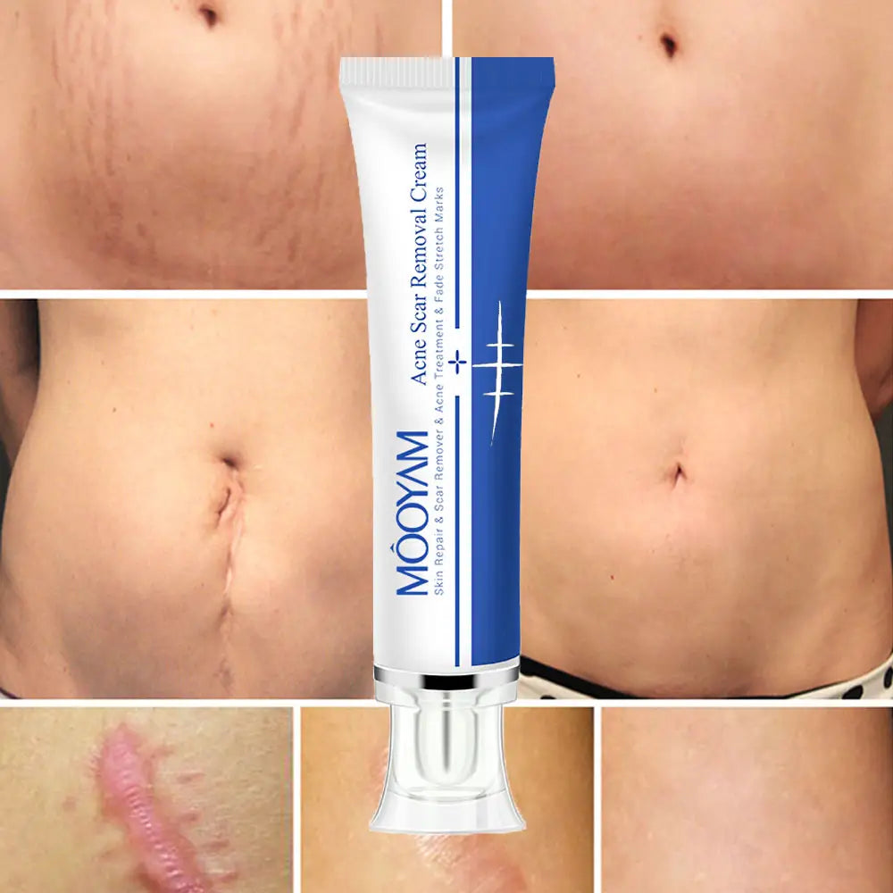 🔥 FLASH SALE — MOOYAM Acne Scar Removal Cream | Fade Dark Spots + Even Skin Tone | KSh 1,800