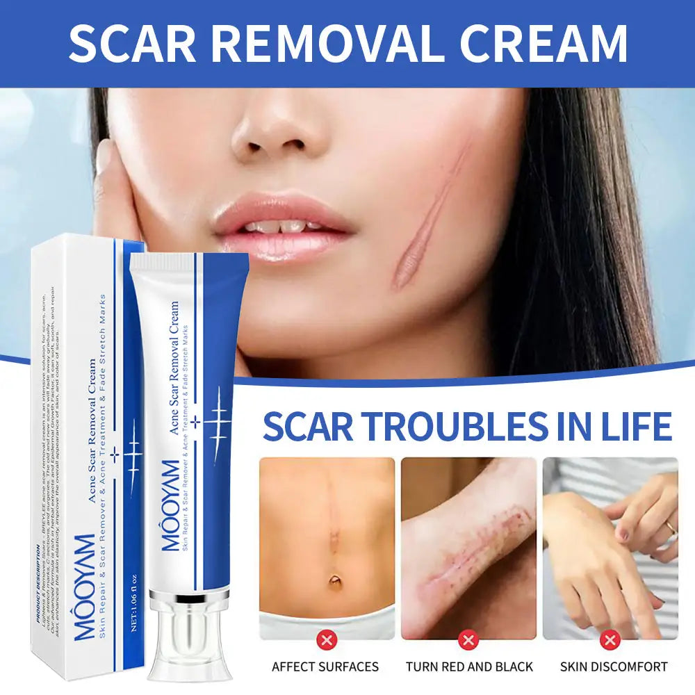 🔥 FLASH SALE — MOOYAM Acne Scar Removal Cream | Fade Dark Spots + Even Skin Tone | KSh 1,800