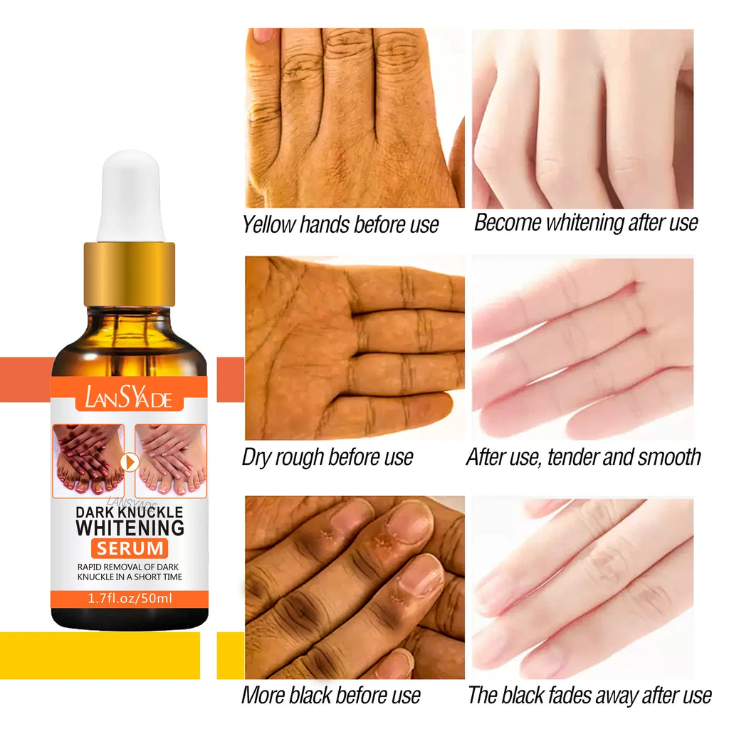 🔥 LIMITED DEAL — LansYade Dark Knuckle Whitening Serum 50ml | Fades Dark Knuckles + Brightens Elbows & Knees + Evens Skin Tone | KSh 1,500