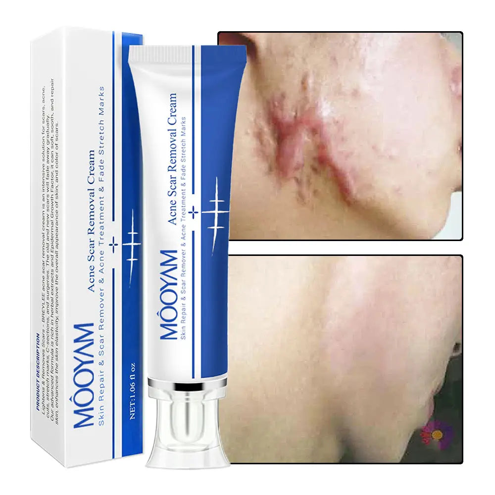 🔥 FLASH SALE — MOOYAM Acne Scar Removal Cream | Fade Dark Spots + Even Skin Tone | KSh 1,800