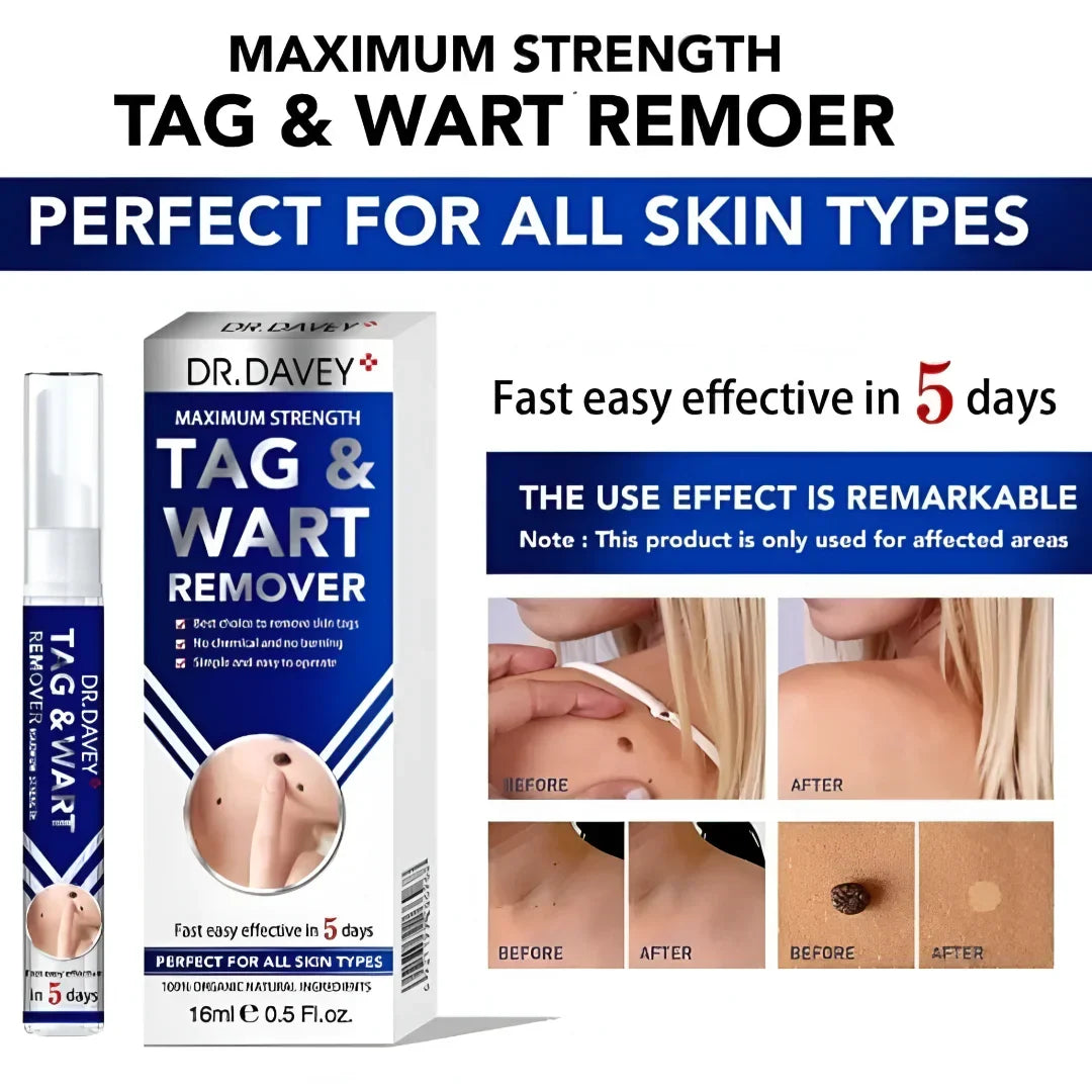 Dr Davey Maximum Strength Tag & Wart Remover | Dries Out & Drops Off Naturally in 10 Days | Discreet Delivery Countrywide