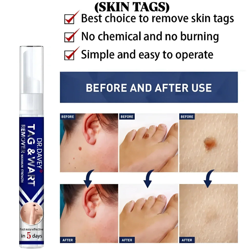 Dr Davey Maximum Strength Tag & Wart Remover | Dries Out & Drops Off Naturally in 10 Days | Discreet Delivery Countrywide