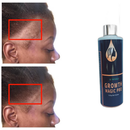 SG Naturals Growth Magic Pro 10 Days Hair Saviour 2