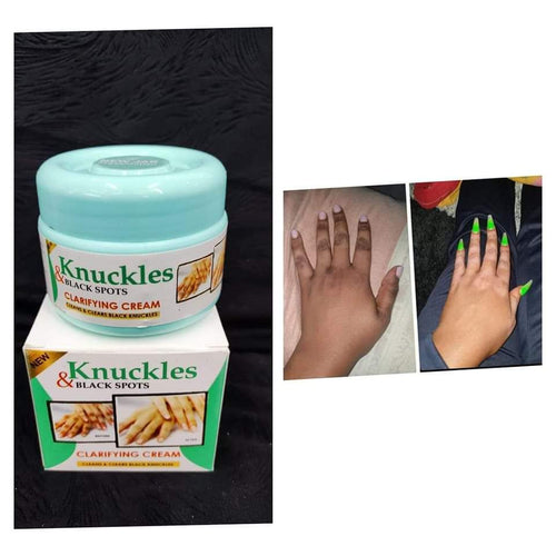 Skin Beauty Black Spot Cream | Erase Dark Knuckles & Elbows ✨ Skin Beauty Black Spot Cream — Fade Dark Knuckles, Elbows & Knees Fast | Clinically Proven Results | Save KSh 25%!Fast | LIMITED STOCK + Surprise Gift! - SAVE KSh 300 TODAY