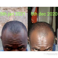 🔥 BUY 1 GET 1 FREE — King of Ginger 7-Day Hair Growth Oil | Stop Breakage + Regrow Hair | KSh 1,800 (D)