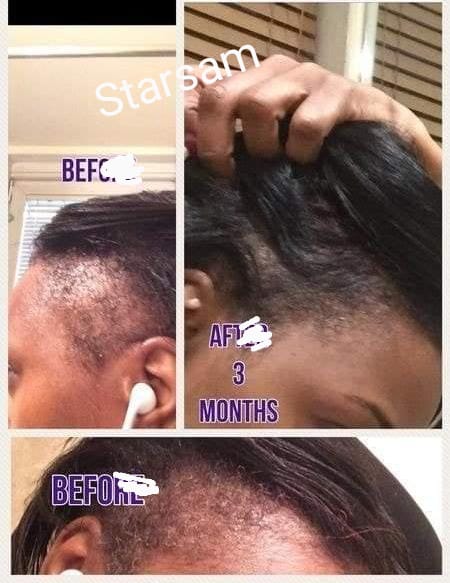 🔥 BUY 1 GET 1 FREE — King of Ginger 7-Day Hair Growth Oil | Stop Breakage + Regrow Hair | KSh 1,800 (E)