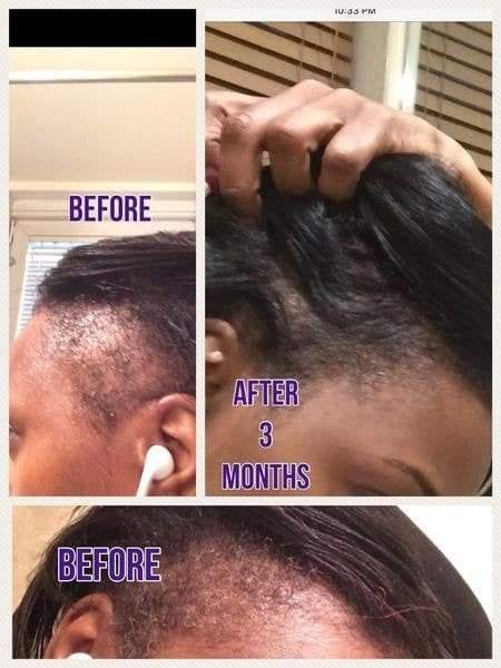 🔥 ORDER 1, WE SEND 2 — KING OF GINGER 7-Day Hair Growth Oil | Stimulates Growth + Anti-Breakage + Hair Loss Treatment | KSh 1,800