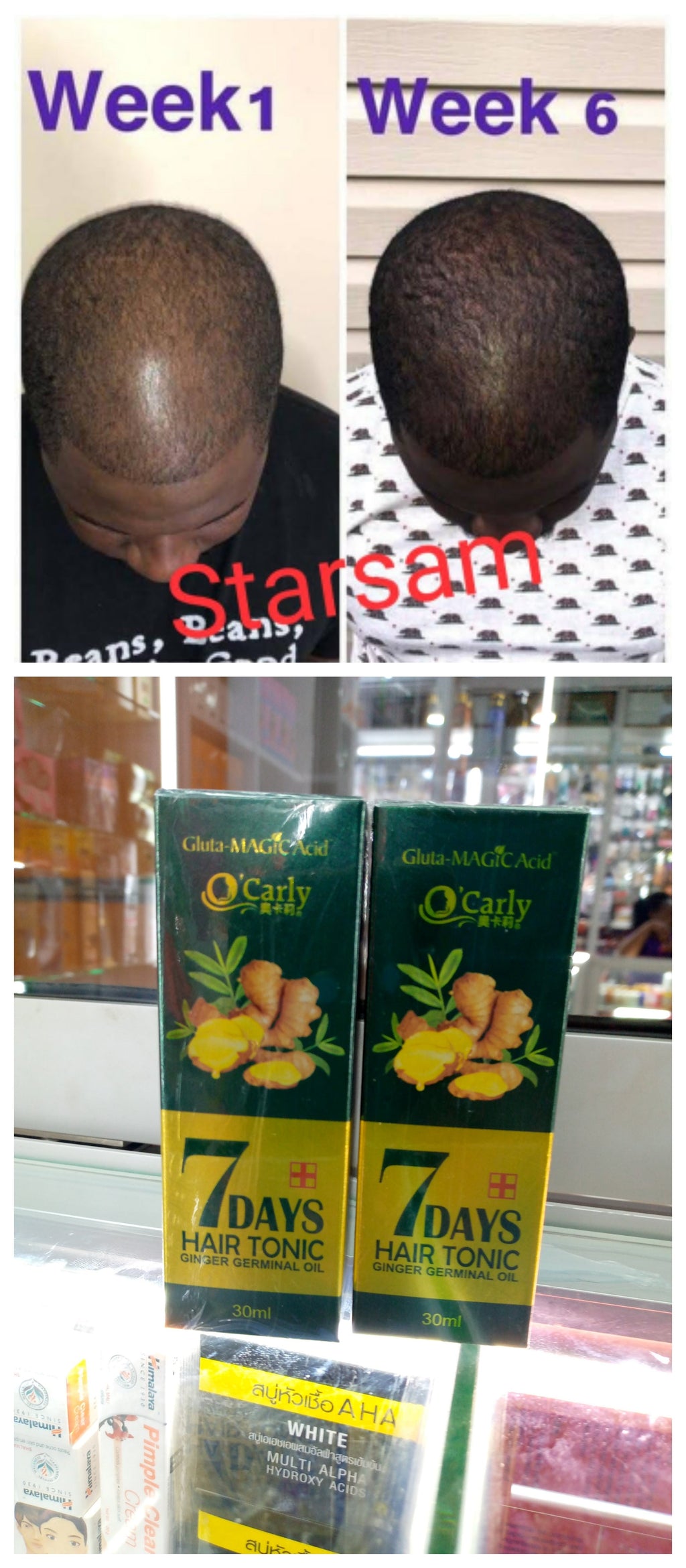 🔥 BUY 1 GET 1 FREE — King of Ginger 7-Day Hair Growth Oil | Stop Breakage + Regrow Hair | KSh 1,800 (D)