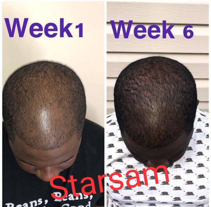 🔥 BUY 1 GET 1 FREE — King of Ginger 7-Day Hair Growth Oil | Stop Breakage + Regrow Hair | KSh 1,800