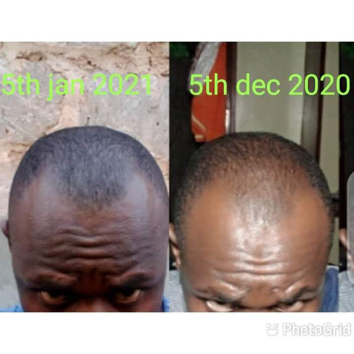 🔥 BUY 1 GET 1 FREE — King of Ginger 7-Day Hair Growth Oil | Stop Breakage + Regrow Hair | KSh 1,800 (A))
