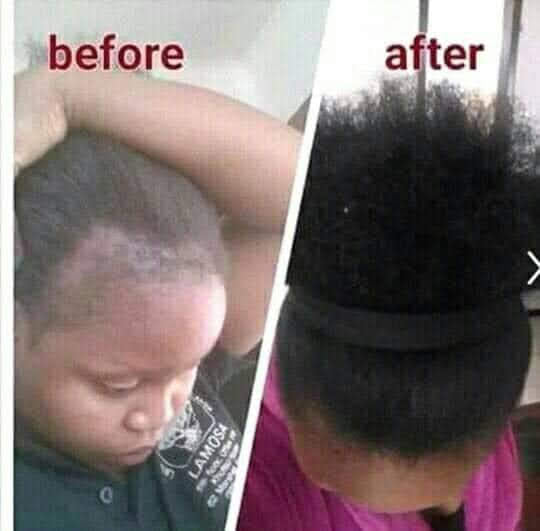 🔥 BUY 1 GET 1 FREE — King of Ginger 7-Day Hair Growth Oil | Stop Breakage + Regrow Hair | KSh 1,800 (B)