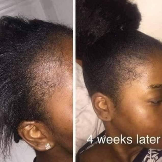 🔥 ORDER 1, WE SEND 2 — KING OF GINGER 7-Day Hair Growth Oil | Stimulates Growth + Stops Breakage + Anti Hair Loss | KSh 1,800
