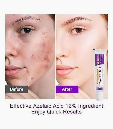Sauvasine Azelaic Acid 12% Facial Cream with Hyaluronic Acid & Niacinamide – Fade Dark Spots, Acne & Redness